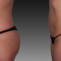 lipoescultura laser